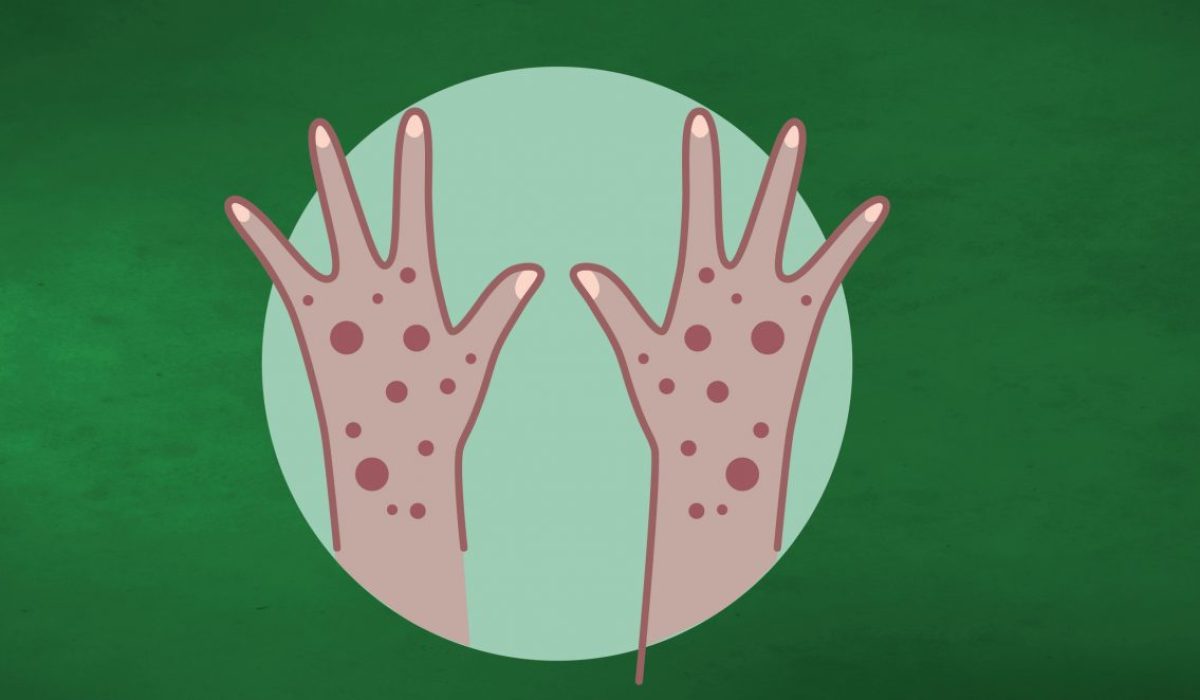 MPox support-01